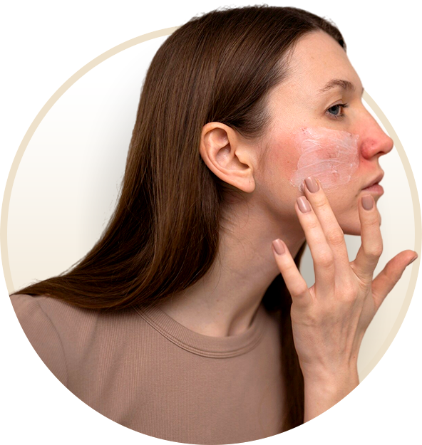 Rosacea